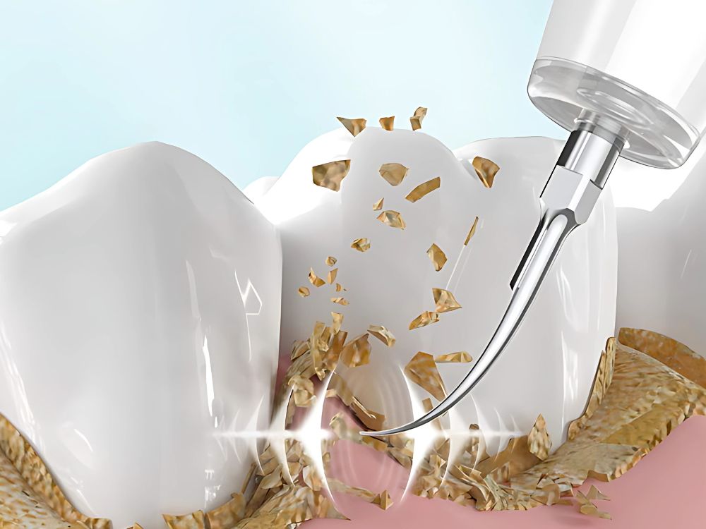 Výkonný ultrazvukový odstraňovač zubného kameňa